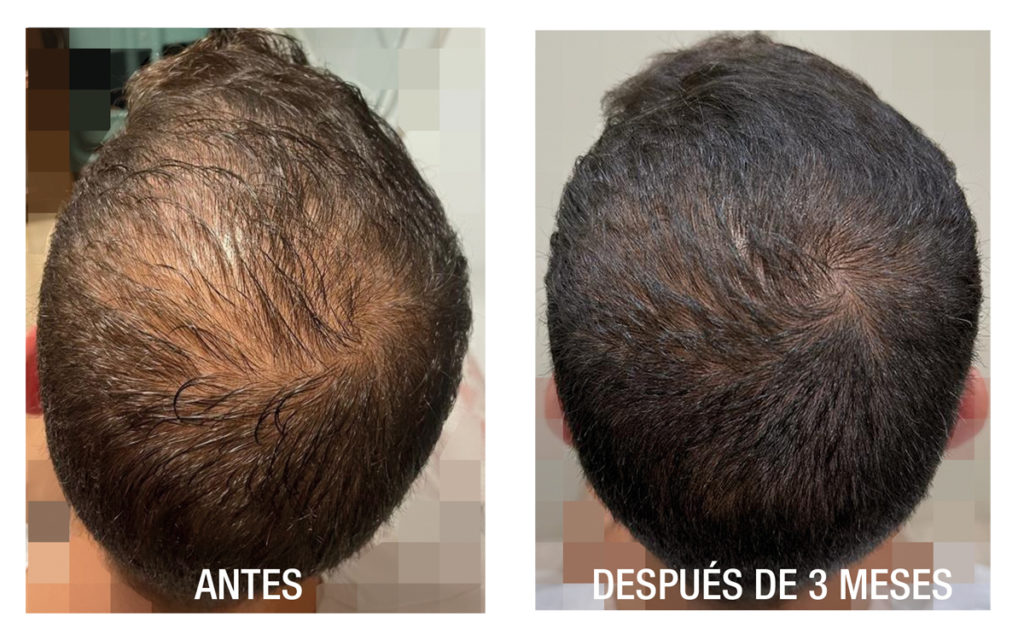 Antes y después caída cabello péptidos