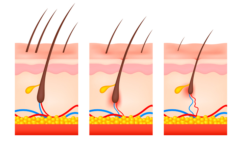 Ilustración del esquema de pérdida de cabello, mostrando la progresión desde un folículo sano hasta un folículo miniaturizado, con cambios en el tamaño y estructura del folículo piloso.