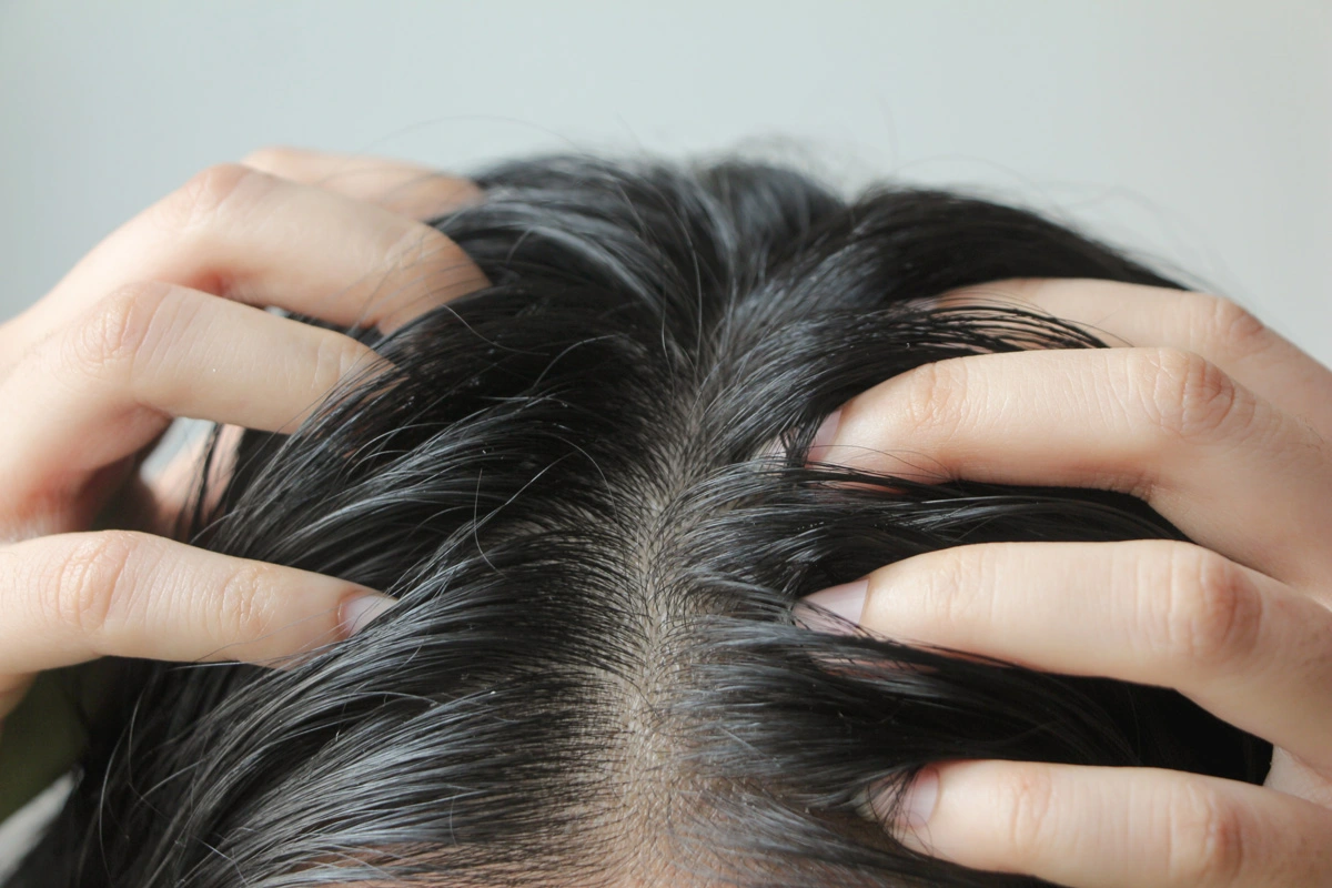 Manos separando el cabello para mostrar un cuero cabelludo con exceso de sebo.