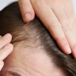 "Persona mostrando el cuero cabelludo con síntomas de irritación o pérdida de cabello.