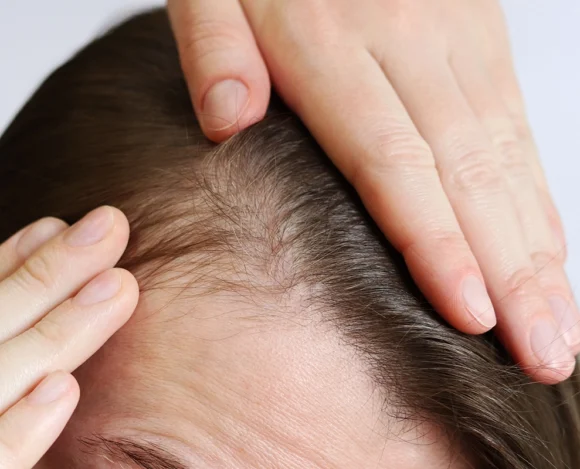 "Persona mostrando el cuero cabelludo con síntomas de irritación o pérdida de cabello.
