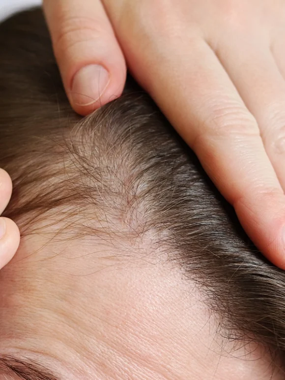 "Persona mostrando el cuero cabelludo con síntomas de irritación o pérdida de cabello.
