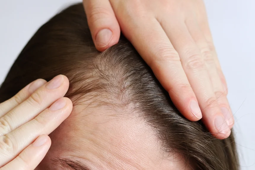 "Persona mostrando el cuero cabelludo con síntomas de irritación o pérdida de cabello.